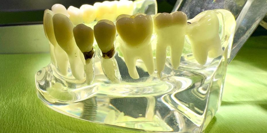 Endodoncia  MURCIA